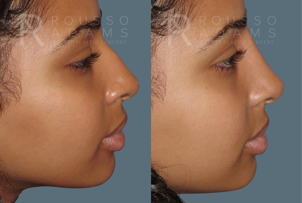 Liquid Rhinoplasty Gallery Before & After Gallery - Patient 354012 - Image 1