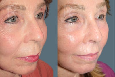 Deep Plane Facelift <span class=small>By Dr. Austin Adams</span> Before & After Gallery - Patient 232180 - Image 4