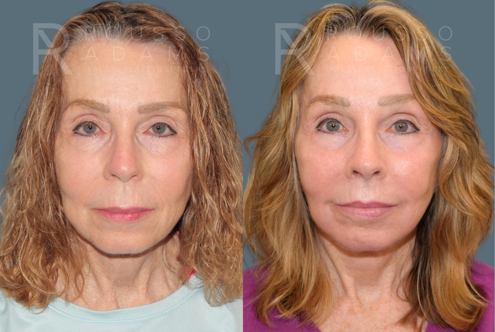 Deep Plane Facelift <span class=small>By Dr. Austin Adams</span> Before & After Gallery - Patient 232180 - Image 2