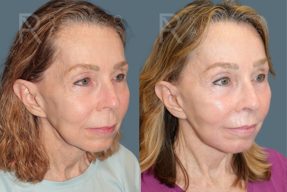 Deep Plane Facelift <span class=small>By Dr. Austin Adams</span> Before & After Gallery - Patient 232180 - Image 1