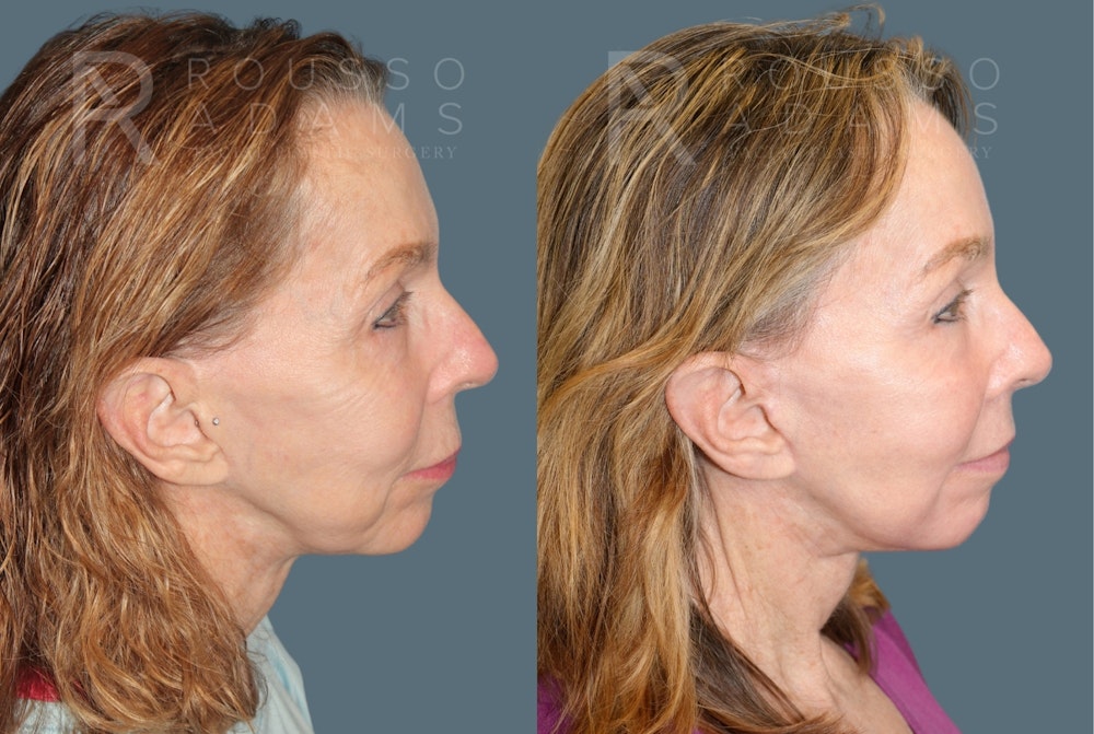 Deep Plane Facelift <span class=small>By Dr. Austin Adams</span> Before & After Gallery - Patient 232180 - Image 3