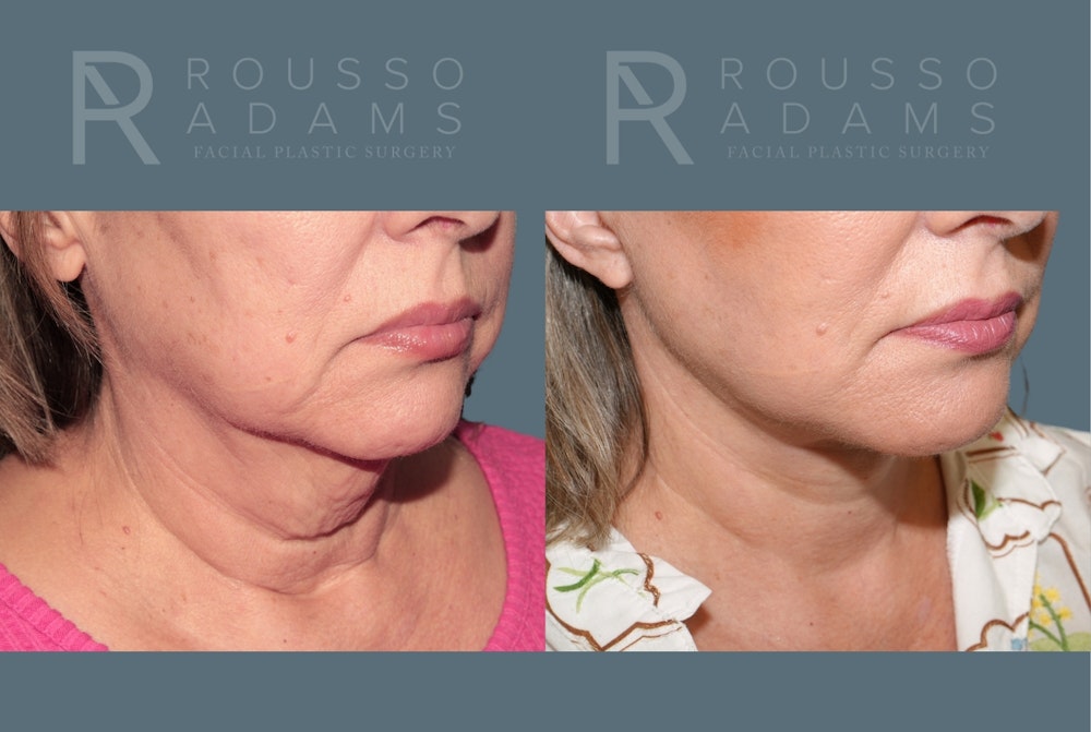 Deep Plane Facelift <span class=small>By Dr. Austin Adams</span> Before & After Gallery - Patient 422609 - Image 5