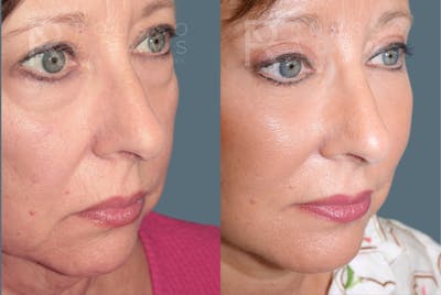 Deep Plane Facelift <span class=small>By Dr. Austin Adams</span> Before & After Gallery - Patient 422609 - Image 4