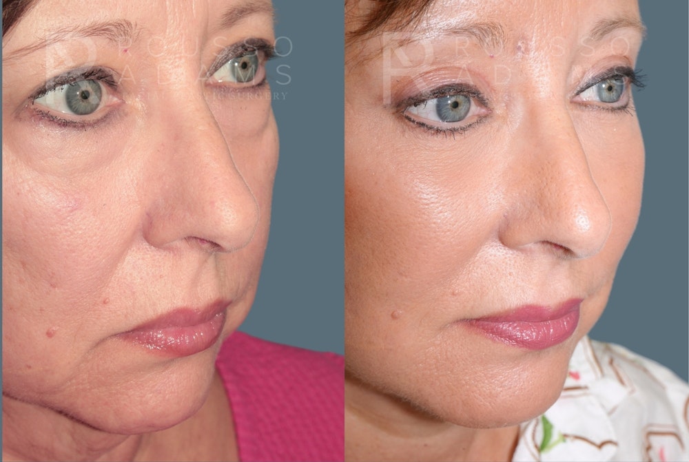 Deep Plane Facelift <span class=small>By Dr. Austin Adams</span> Before & After Gallery - Patient 422609 - Image 4