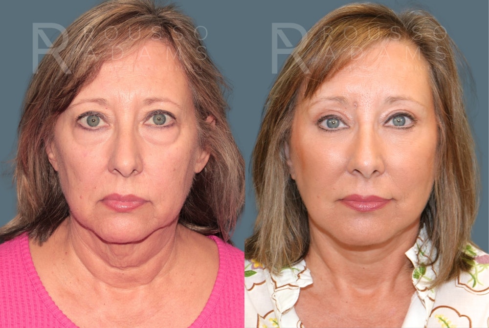 Deep Plane Facelift <span class=small>By Dr. Austin Adams</span> Before & After Gallery - Patient 422609 - Image 2