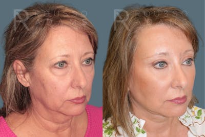 Deep Plane Facelift <span class=small>By Dr. Austin Adams</span> Before & After Gallery - Patient 422609 - Image 1