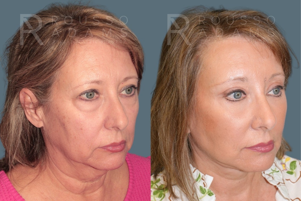 Deep Plane Facelift <span class=small>By Dr. Austin Adams</span> Before & After Gallery - Patient 422609 - Image 1