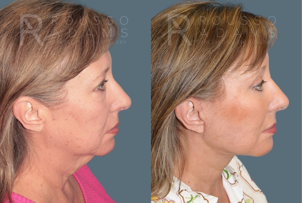Deep Plane Facelift <span class=small>By Dr. Austin Adams</span> Before & After Gallery - Patient 422609 - Image 3