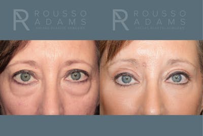 Blepharoplasty<span class=small>By Dr. Austin Adams</span> Before & After Gallery - Patient 423533 - Image 1