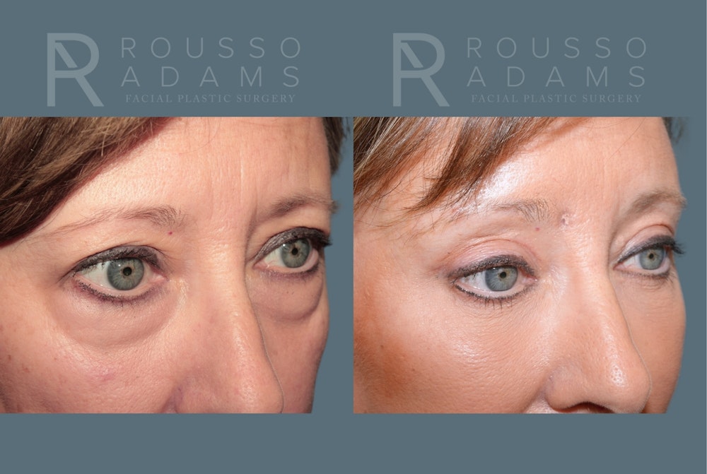 Blepharoplasty<span class=small>By Dr. Austin Adams</span> Before & After Gallery - Patient 423533 - Image 4