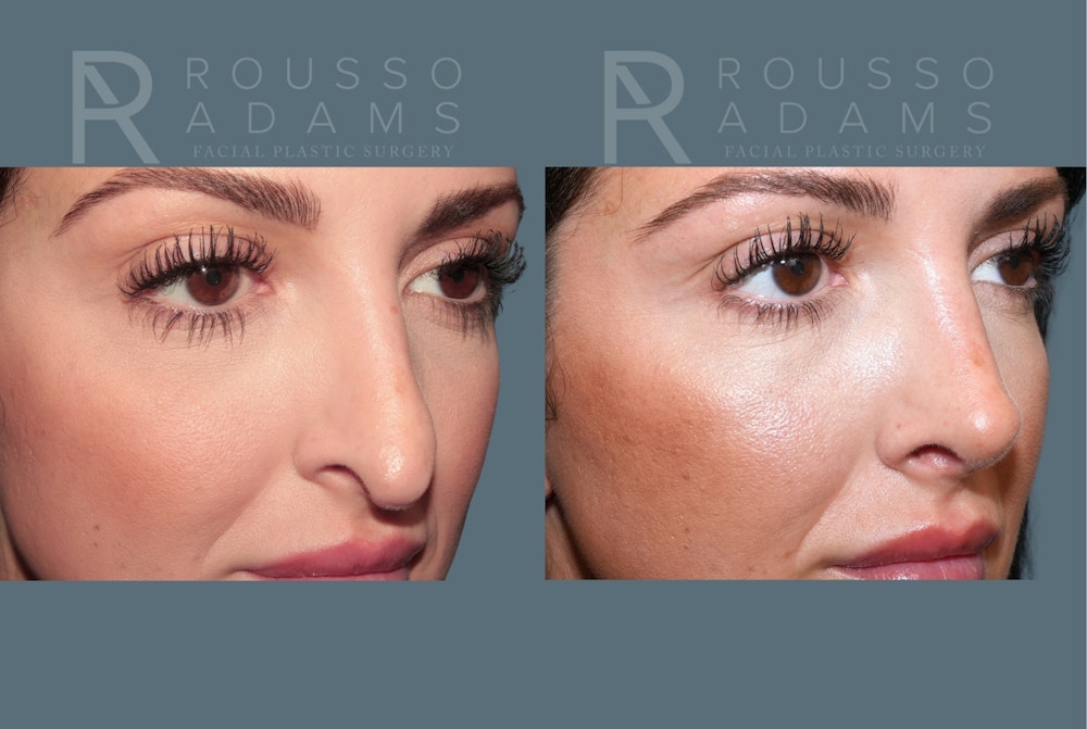 Rhinoplasty <span class=small>By Dr. Daniel Rousso</span> Before & After Gallery - Patient 134898 - Image 5