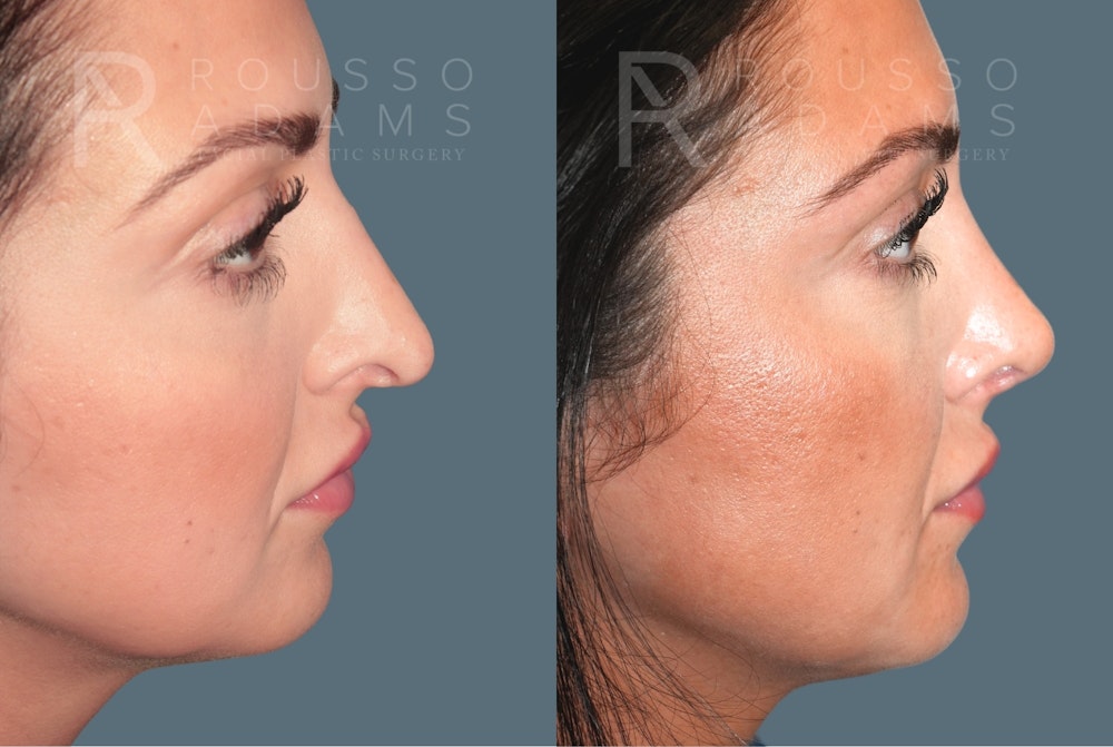 Rhinoplasty <span class=small>By Dr. Daniel Rousso</span> Before & After Gallery - Patient 134898 - Image 4