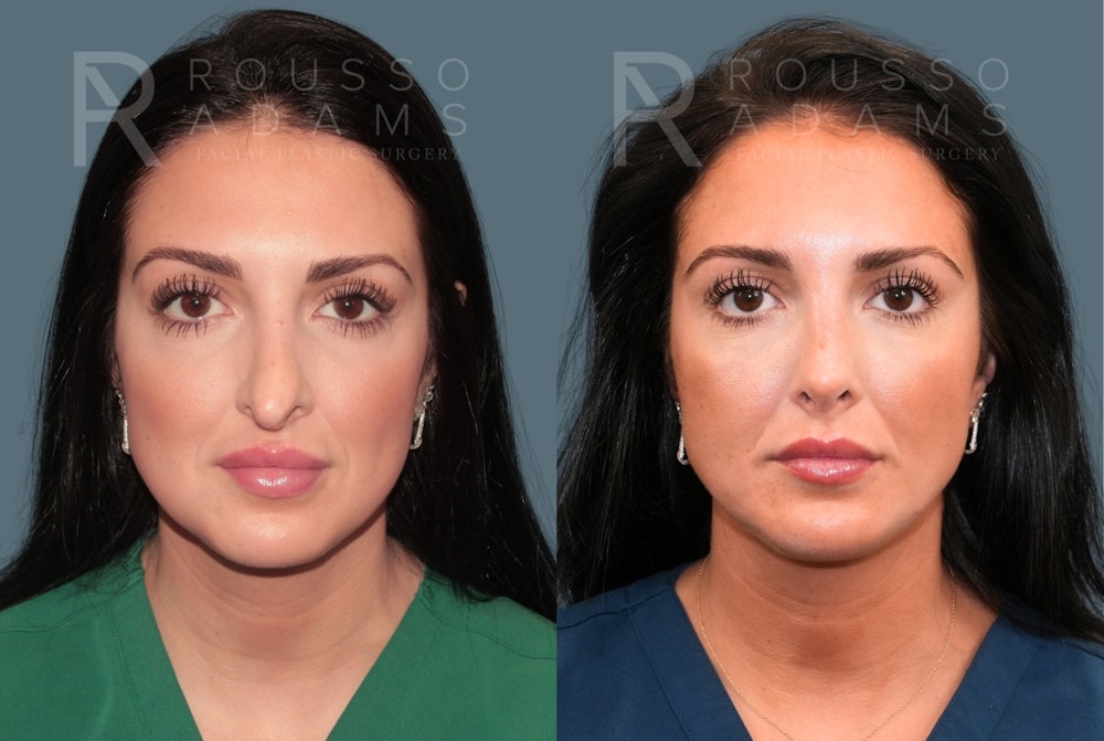 Rhinoplasty <span class=small>By Dr. Daniel Rousso</span> Before & After Gallery - Patient 134898 - Image 2