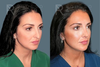 Revision Rhinoplasty <span class=small>By Dr. Daniel Rousso</span> Before & After Gallery - Patient 423049 - Image 1