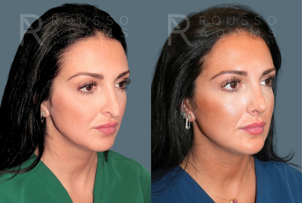 Rhinoplasty <span class=small>By Dr. Daniel Rousso</span> Before & After Gallery - Patient 134898 - Image 3