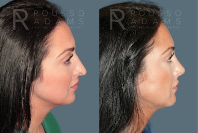 Rhinoplasty <span class=small>By Dr. Daniel Rousso</span> Before & After Gallery - Patient 134898 - Image 1