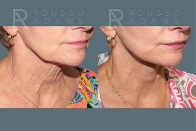 Deep Plane Facelift <span class=small>By Dr. Daniel Rousso</span> Before & After Gallery - Patient 390494 - Image 4