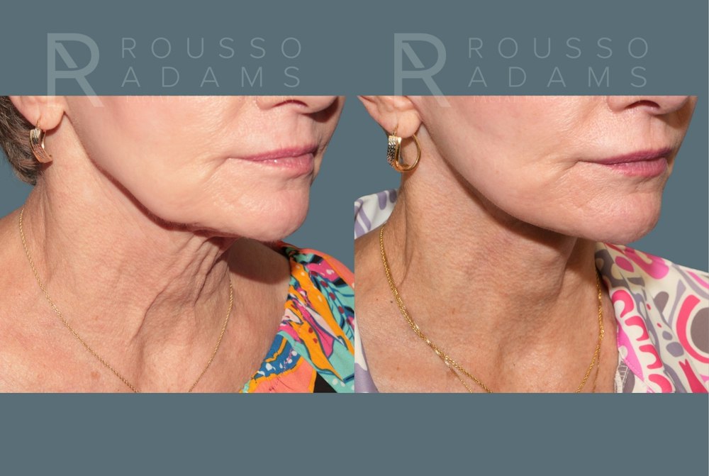 Deep Plane Facelift <span class=small>By Dr. Daniel Rousso</span> Before & After Gallery - Patient 390494 - Image 4