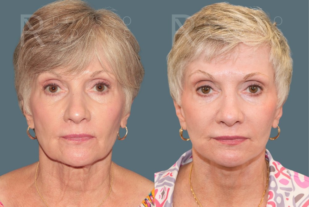 Deep Plane Facelift <span class=small>By Dr. Daniel Rousso</span> Before & After Gallery - Patient 390494 - Image 2
