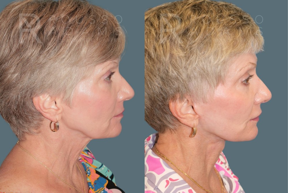 Deep Plane Facelift <span class=small>By Dr. Daniel Rousso</span> Before & After Gallery - Patient 390494 - Image 3
