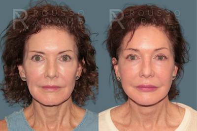 Deep Plane Facelift <span class=small>By Dr. Daniel Rousso</span> Before & After Gallery - Patient 346243 - Image 2
