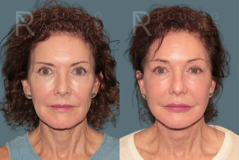 Deep Plane Facelift <span class=small>By Dr. Daniel Rousso</span> Before & After Gallery - Patient 346243 - Image 2