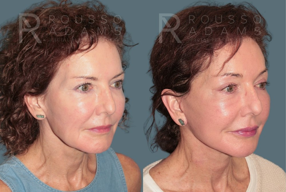 Deep Plane Facelift <span class=small>By Dr. Daniel Rousso</span> Before & After Gallery - Patient 346243 - Image 1