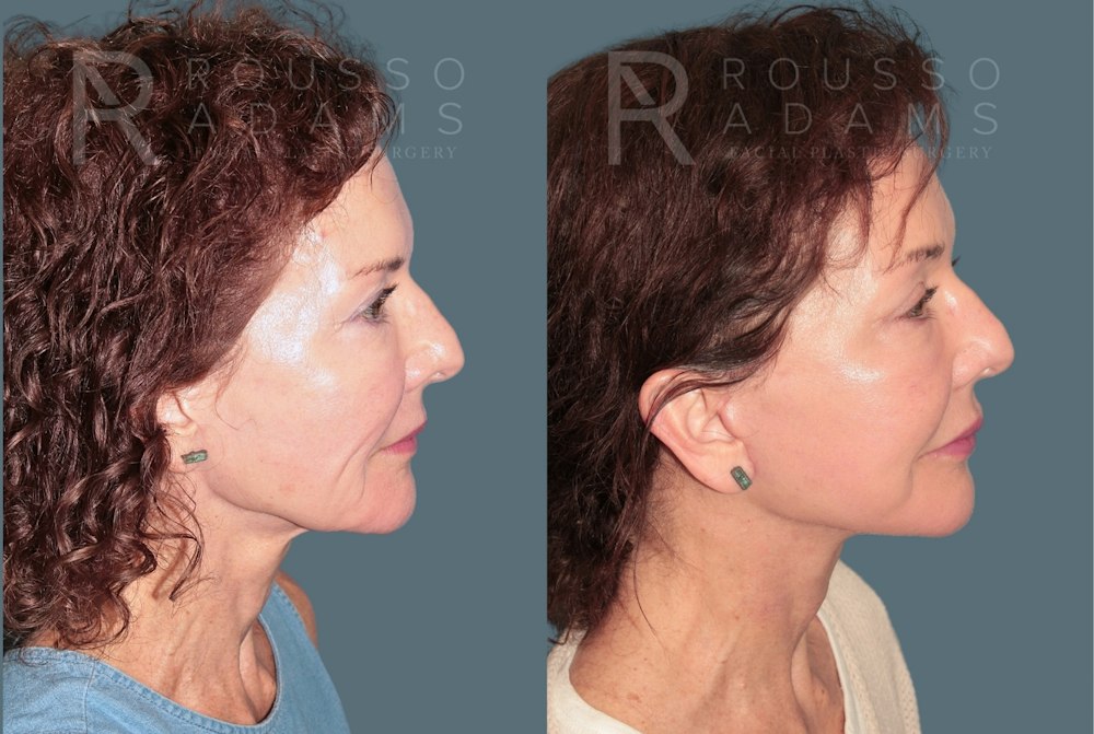 Deep Plane Facelift <span class=small>By Dr. Daniel Rousso</span> Before & After Gallery - Patient 346243 - Image 3