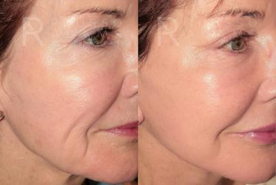 Deep Plane Facelift <span class=small>By Dr. Daniel Rousso</span> Before & After Gallery - Patient 346243 - Image 4