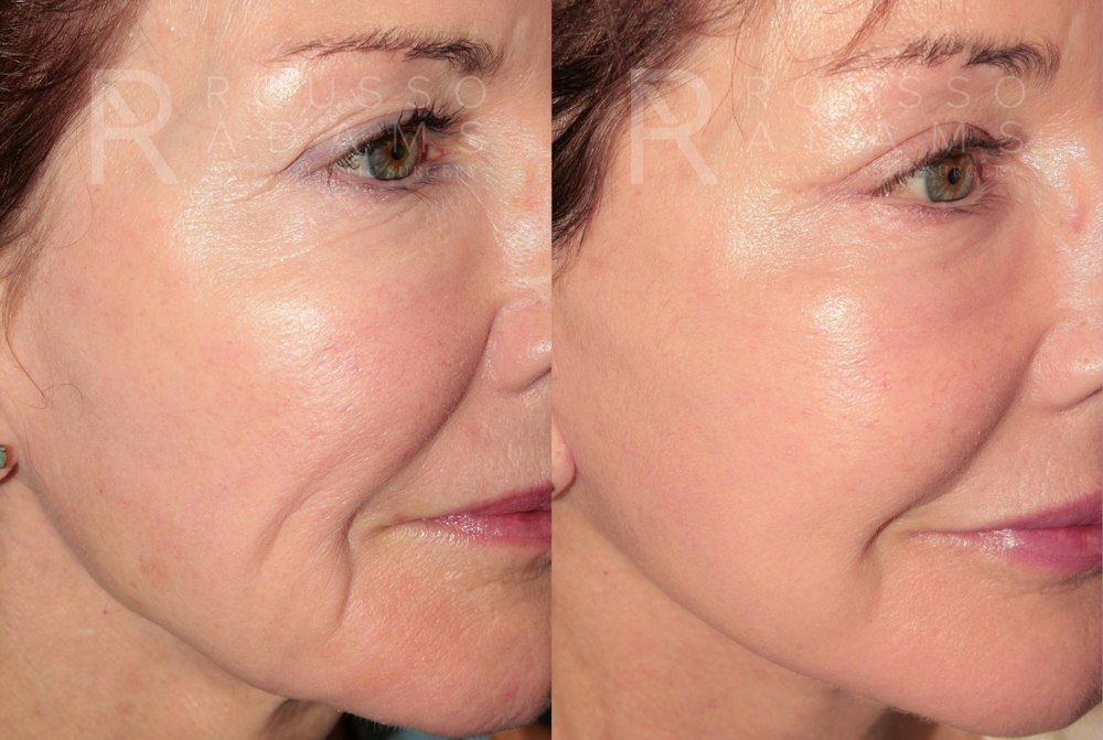 Deep Plane Facelift <span class=small>By Dr. Daniel Rousso</span> Before & After Gallery - Patient 346243 - Image 4