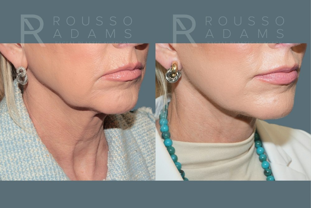 Deep Plane Facelift <span class=small>By Dr. Daniel Rousso</span> Before & After Gallery - Patient 224421 - Image 5