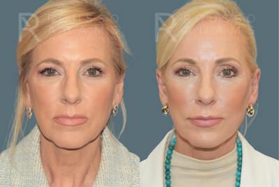 Deep Plane Facelift <span class=small>By Dr. Daniel Rousso</span> Before & After Gallery - Patient 224421 - Image 2