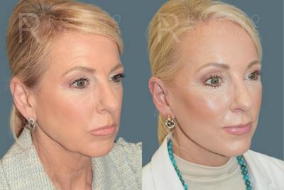 Deep Plane Facelift <span class=small>By Dr. Daniel Rousso</span> Before & After Gallery - Patient 224421 - Image 1