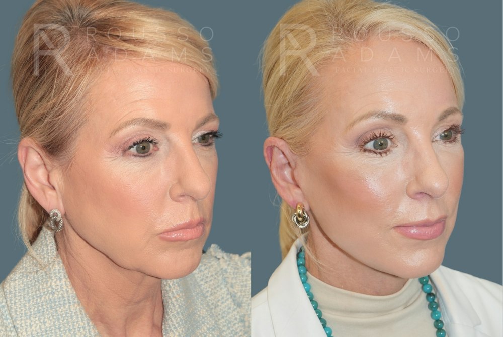 Deep Plane Facelift <span class=small>By Dr. Daniel Rousso</span> Before & After Gallery - Patient 224421 - Image 1
