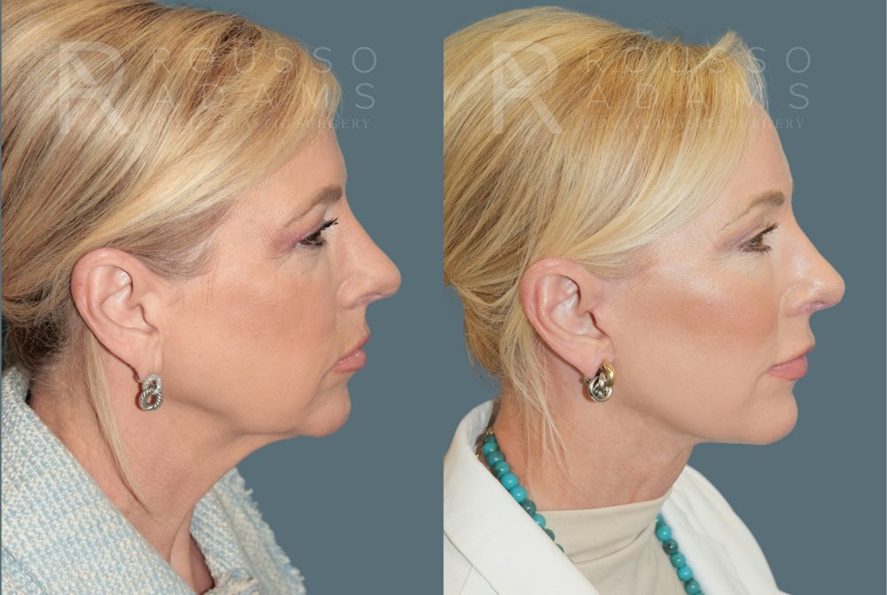 Deep Plane Facelift <span class=small>By Dr. Daniel Rousso</span> Before & After Gallery - Patient 224421 - Image 3