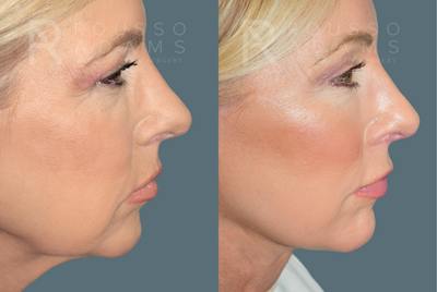 Deep Plane Facelift <span class=small>By Dr. Daniel Rousso</span> Before & After Gallery - Patient 224421 - Image 4