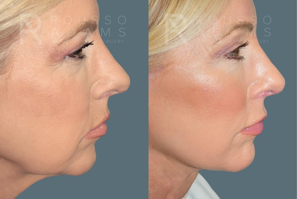 Deep Plane Facelift <span class=small>By Dr. Daniel Rousso</span> Before & After Gallery - Patient 224421 - Image 4