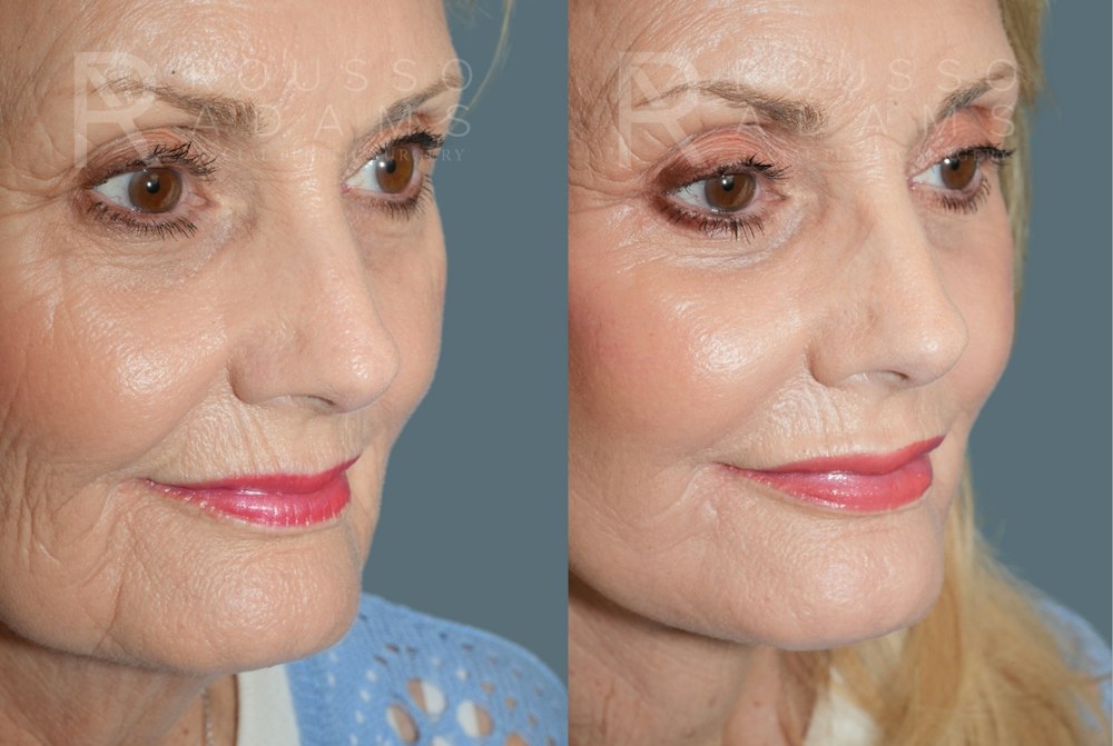 Deep Plane Facelift <span class=small>By Dr. Daniel Rousso</span> Before & After Gallery - Patient 169849 - Image 5