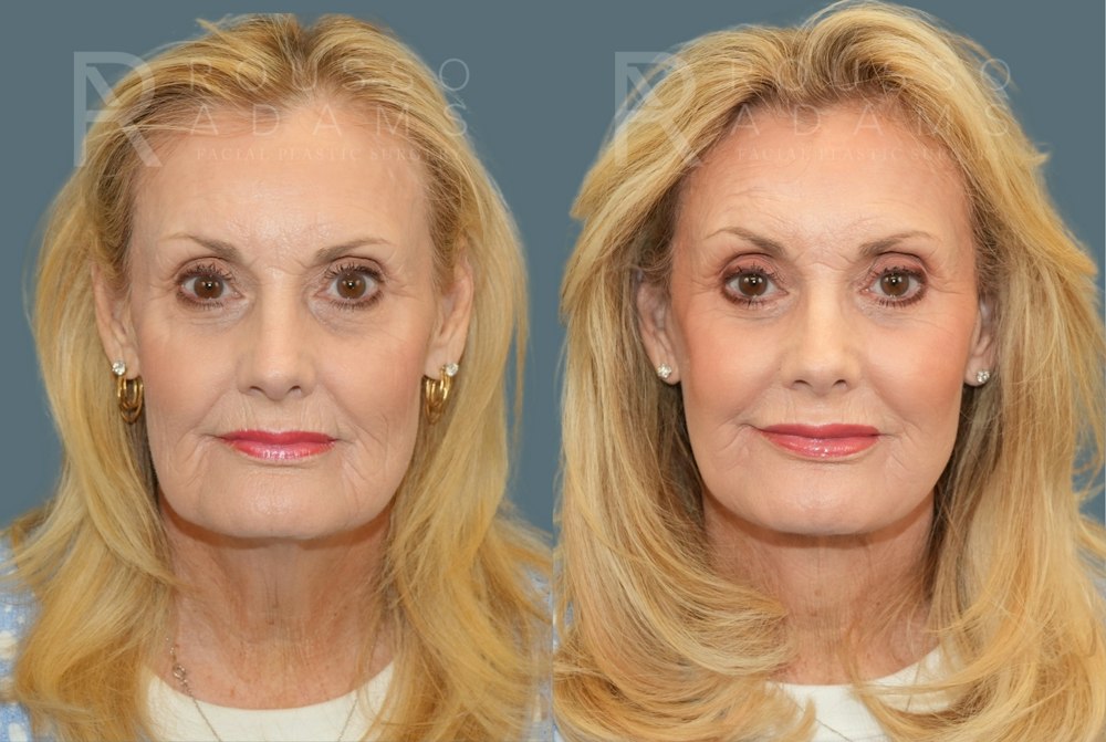 Deep Plane Facelift <span class=small>By Dr. Daniel Rousso</span> Before & After Gallery - Patient 169849 - Image 3