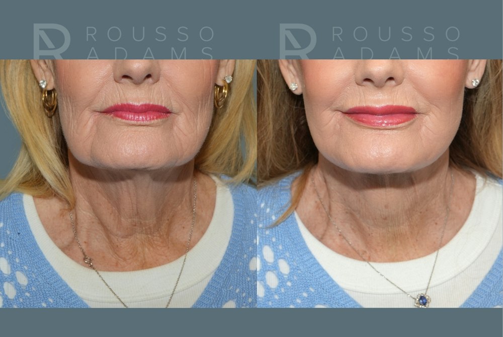 Deep Plane Facelift <span class=small>By Dr. Daniel Rousso</span> Before & After Gallery - Patient 169849 - Image 7