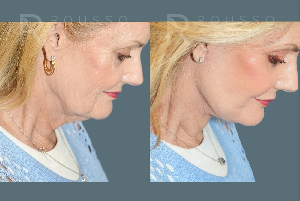Deep Plane Facelift <span class=small>By Dr. Daniel Rousso</span> Before & After Gallery - Patient 169849 - Image 4