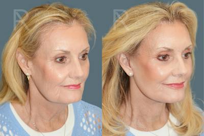 Deep Plane Facelift <span class=small>By Dr. Daniel Rousso</span> Before & After Gallery - Patient 169849 - Image 1