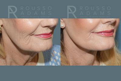 Deep Plane Facelift <span class=small>By Dr. Daniel Rousso</span> Before & After Gallery - Patient 169849 - Image 6