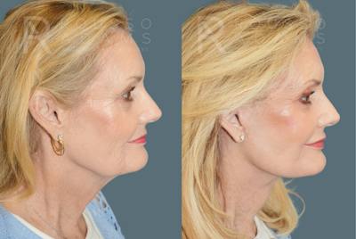 Deep Plane Facelift <span class=small>By Dr. Daniel Rousso</span> Before & After Gallery - Patient 169849 - Image 2