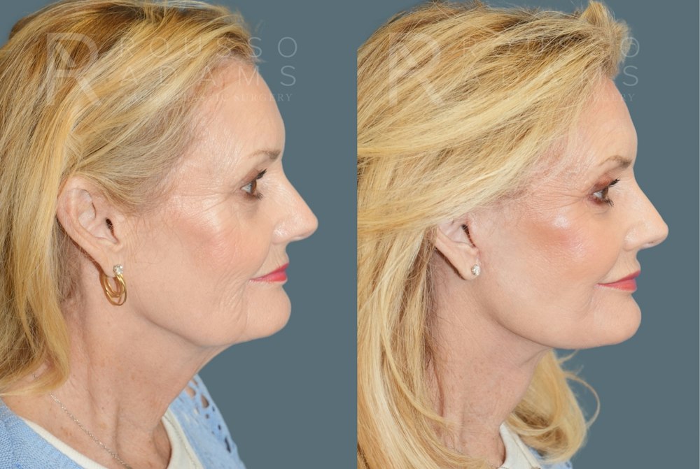 Deep Plane Facelift <span class=small>By Dr. Daniel Rousso</span> Before & After Gallery - Patient 169849 - Image 2