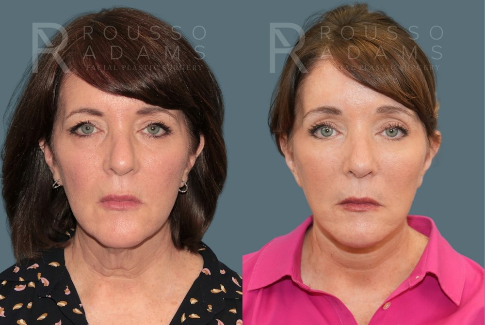 Deep Plane Facelift <span class=small>By Dr. Austin Adams</span> Before & After Gallery - Patient 351877 - Image 2