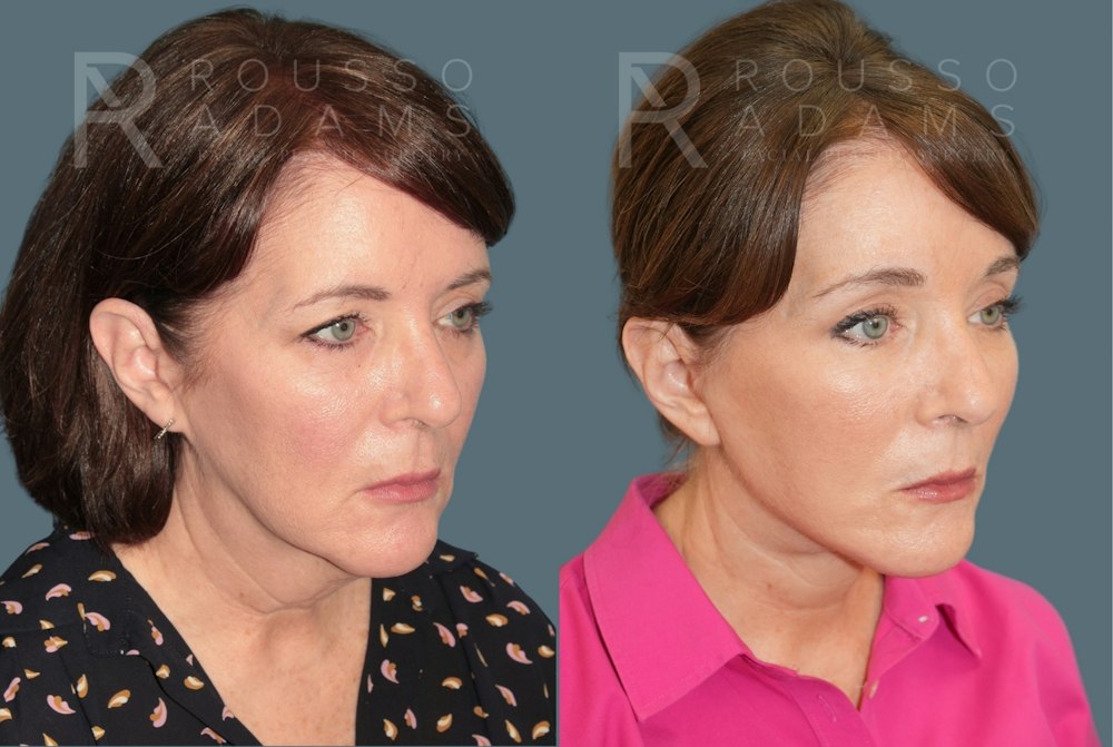 Deep Plane Facelift <span class=small>By Dr. Austin Adams</span> Before & After Gallery - Patient 351877 - Image 1