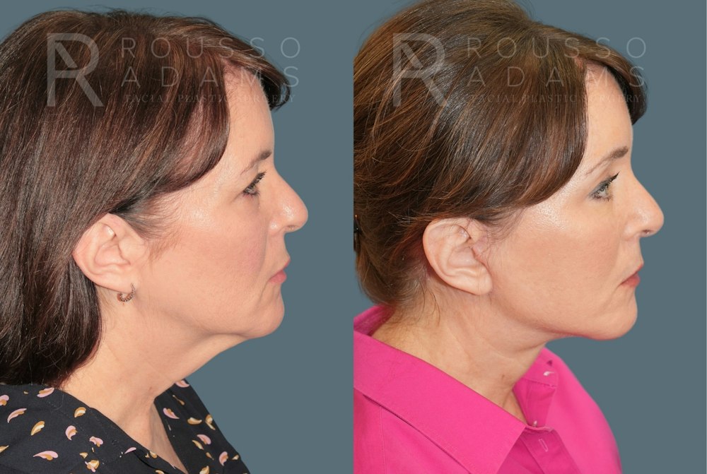 Deep Plane Facelift <span class=small>By Dr. Austin Adams</span> Before & After Gallery - Patient 351877 - Image 3