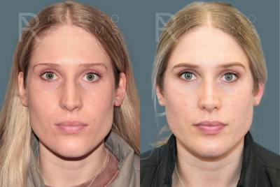 Rhinoplasty<span class=small>By Dr. Austin Adams</span> Before & After Gallery - Patient 299268 - Image 2