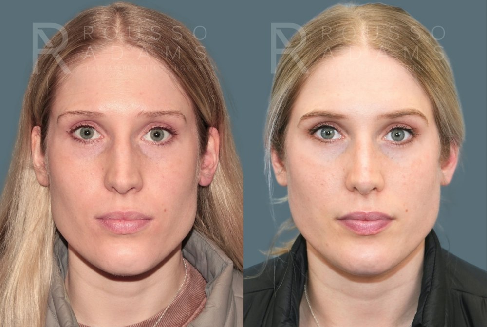 Rhinoplasty<span class=small>By Dr. Austin Adams</span> Before & After Gallery - Patient 299268 - Image 2
